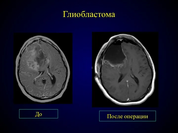 Глиобластома До После операции