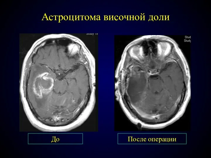 Астроцитома височной доли До После операции