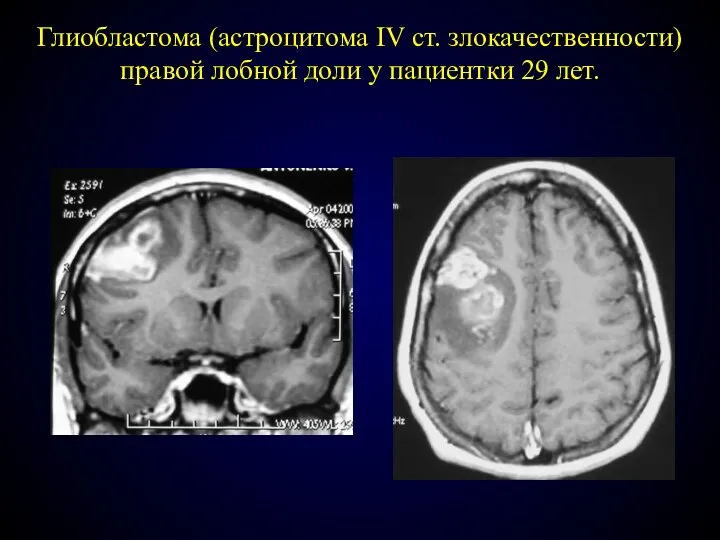 Глиобластома (астроцитома IV ст. злокачественности) правой лобной доли у пациентки 29 лет.