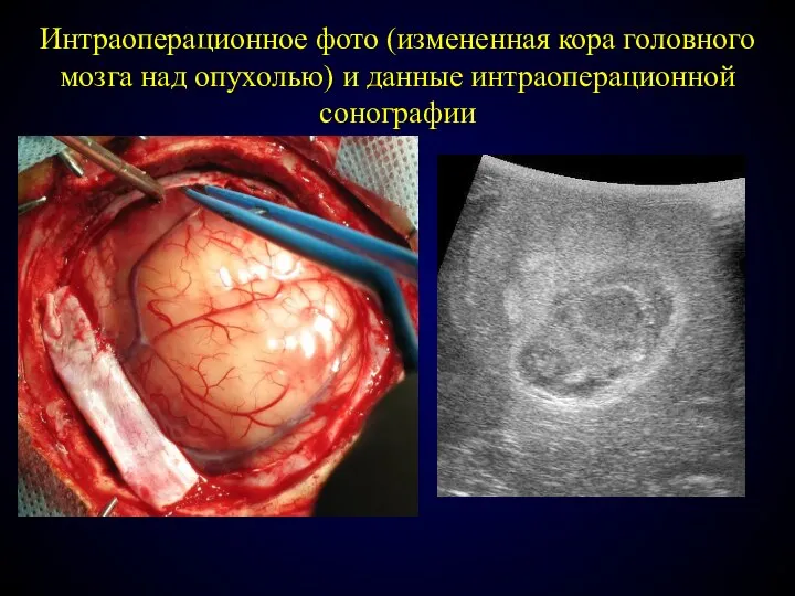 Интраоперационное фото (измененная кора головного мозга над опухолью) и данные интраоперационной сонографии