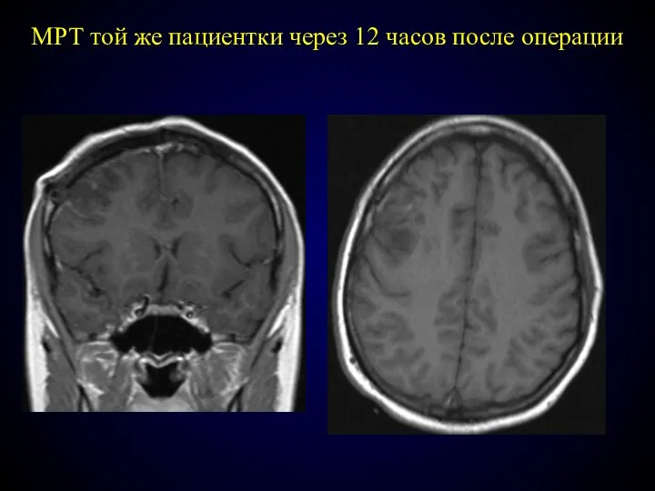 МРТ той же пациентки через 12 часов после опeрации