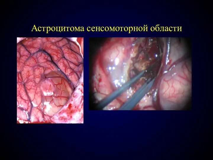 Астроцитома сенсомоторной области