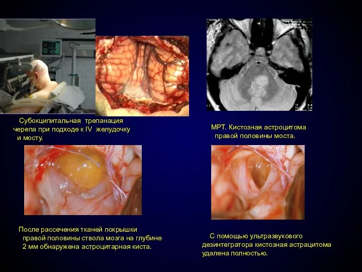 Субокципитальная трепанация черепа при подходе к IV желудочку и мосту. МРТ.