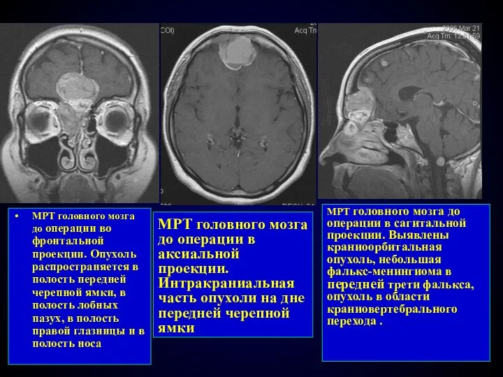 МРТ головного мозга до операции в аксиальной проекции. Интракраниальная часть опухоли