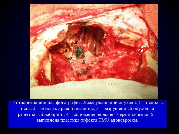 Интраоперационная фотография. Ложе удаленной опухоли: 1 – полость носа, 2 –
