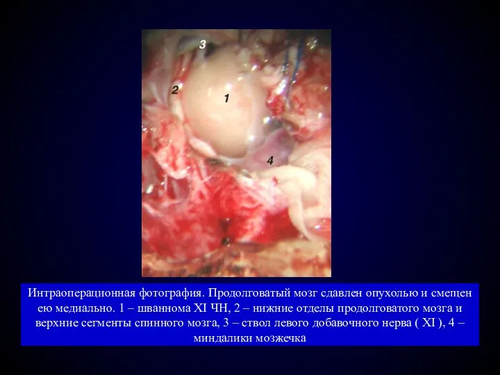 Интраоперационная фотография. Продолговатый мозг сдавлен опухолью и смещен ею медиально. 1