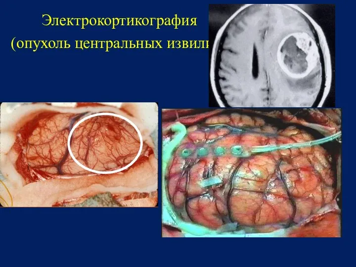 Электрокортикография (опухоль центральных извилин)