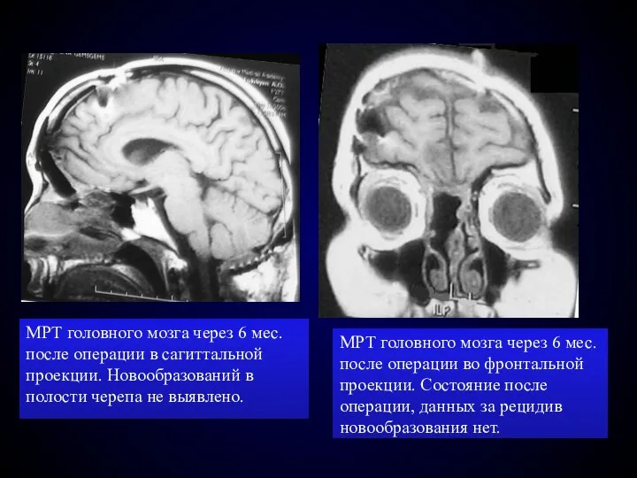 МРТ головного мозга через 6 мес. после операции в сагиттальной проекции.