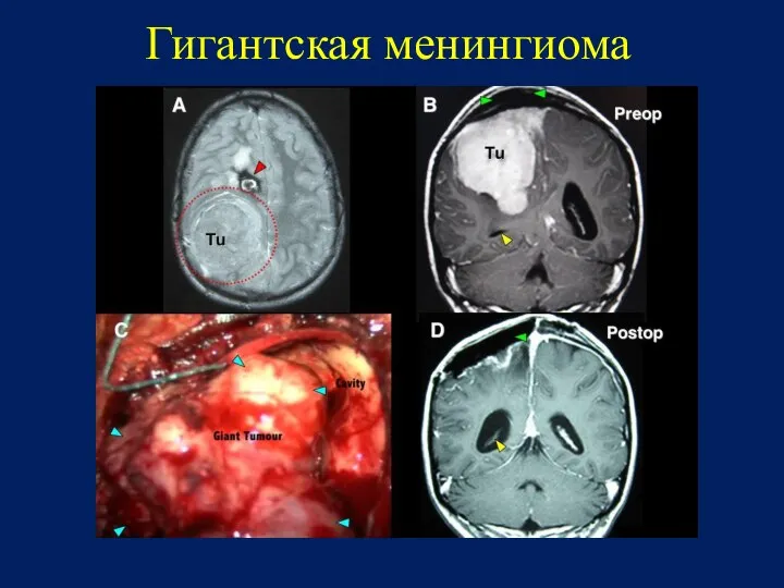 Гигантская менингиома