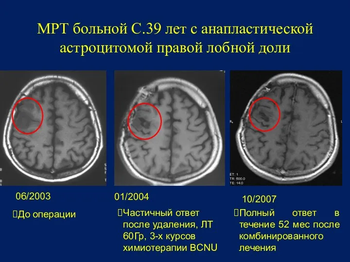 МРТ больной С.39 лет с анапластической астроцитомой правой лобной доли 06/2003