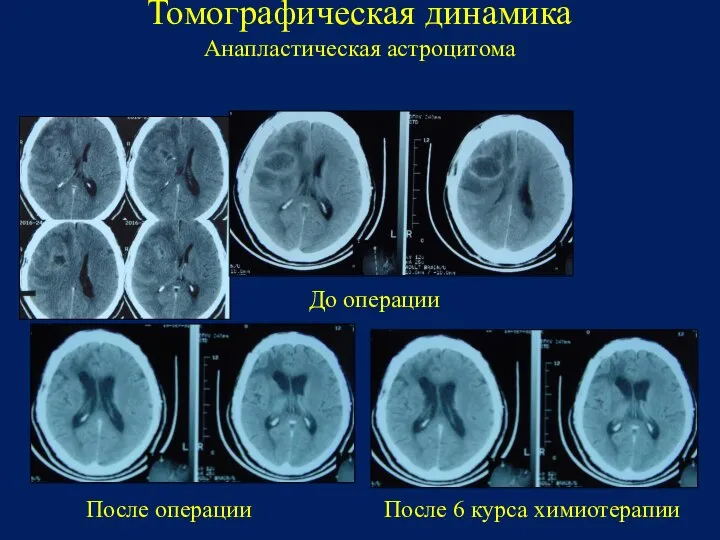 Томографическая динамика Анапластическая астроцитома После 6 курса химиотерапии После операции До операции