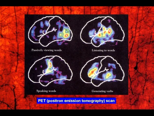 PET (positron emission tomography) scan