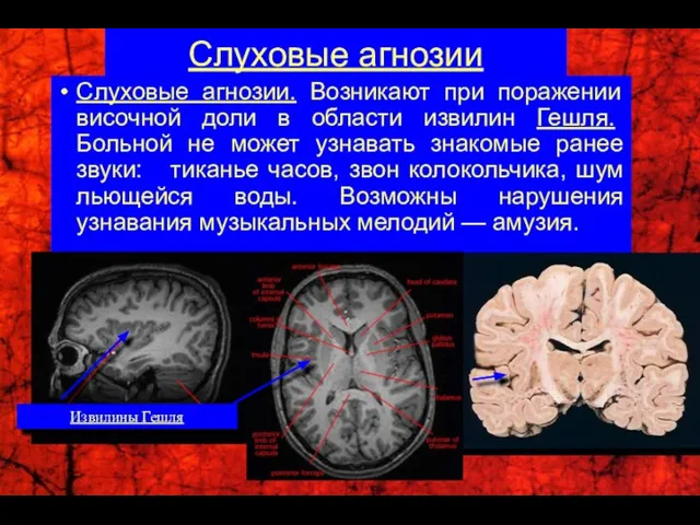 Слуховые агнозии Слуховые агнозии. Возникают при поражении височной доли в области