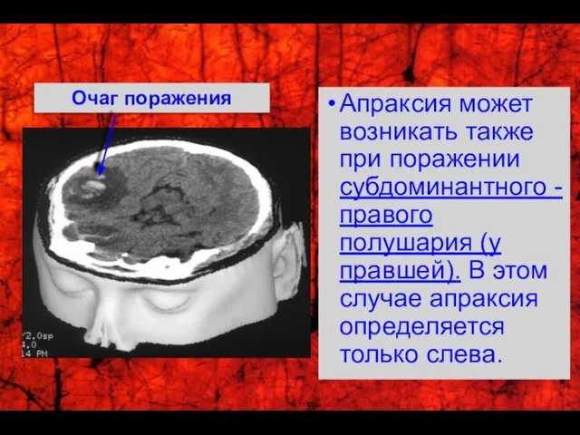 Апраксия может возникать также при поражении субдоминантного - правого полушария (у