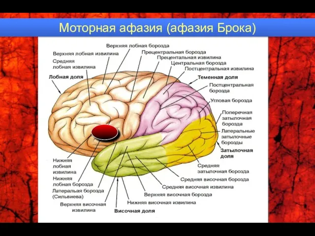 Моторная афазия (афазия Брока)