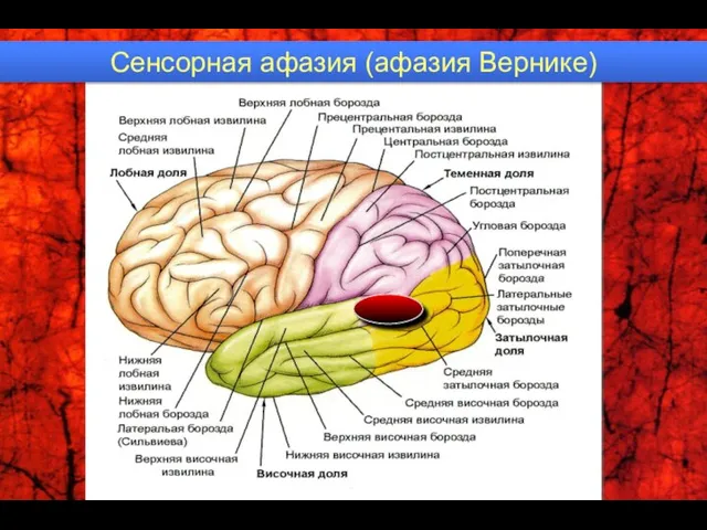 Сенсорная афазия (афазия Вернике)