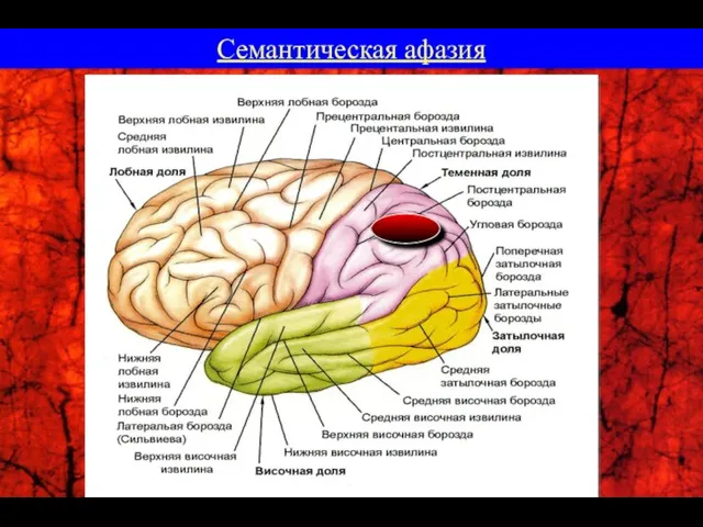 Семантическая афазия