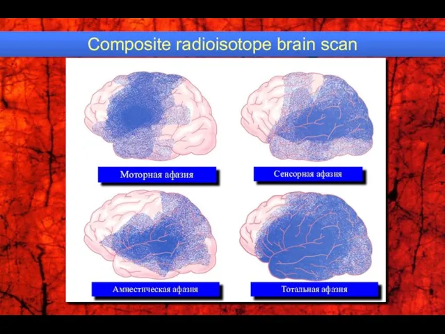 Composite radioisotope brain scan Моторная афазия Сенсорная афазия Амнестическая афазия Тотальная афазия