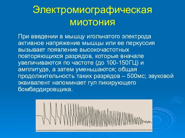 Электромиографическая миотония При введении в мышцу игольчатого электрода активное напряжение мышцы