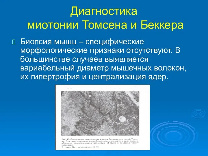 Диагностика миотонии Томсена и Беккера Биопсия мышц – специфические морфологические признаки