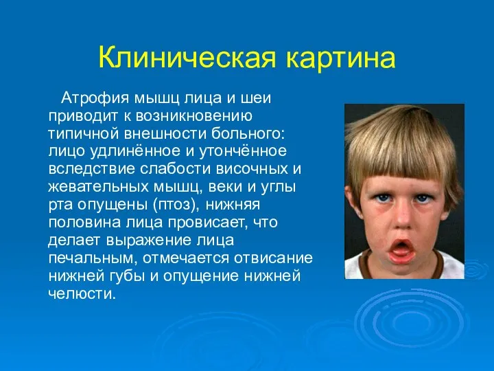 Клиническая картина Атрофия мышц лица и шеи приводит к возникновению типичной