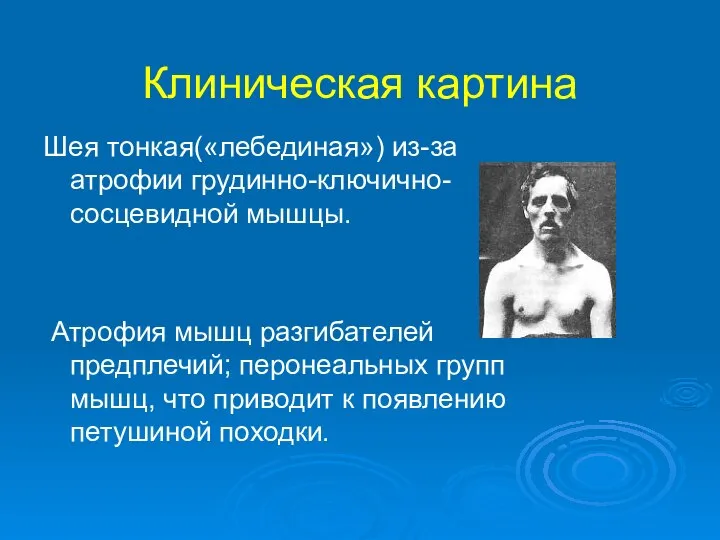 Клиническая картина Шея тонкая(«лебединая») из-за атрофии грудинно-ключично-сосцевидной мышцы. Атрофия мышц разгибателей