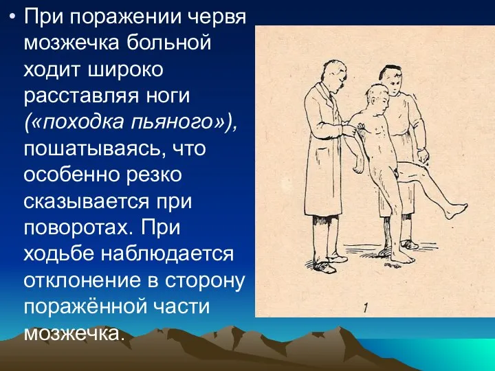 При поражении червя мозжечка больной ходит широко расставляя ноги («походка пьяного»),