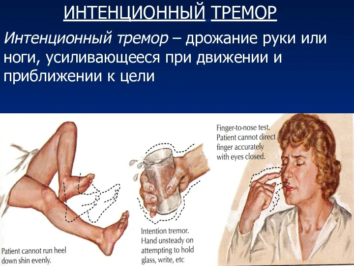 ИНТЕНЦИОННЫЙ ТРЕМОР Интенционный тремор – дрожание руки или ноги, усиливающееся при движении и приближении к цели