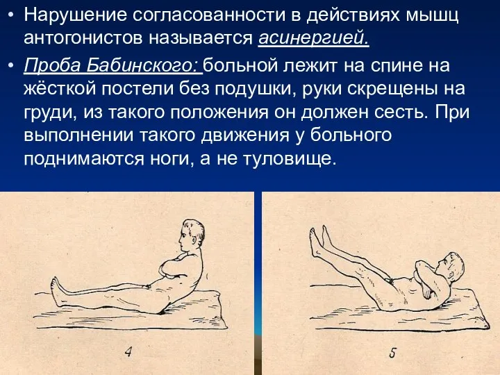 Нарушение согласованности в действиях мышц антогонистов называется асинергией. Проба Бабинского: больной