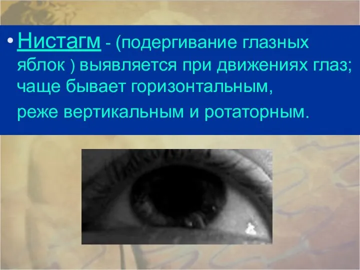 Нистагм - (подергивание глазных яблок ) выявляется при движениях глаз; чаще