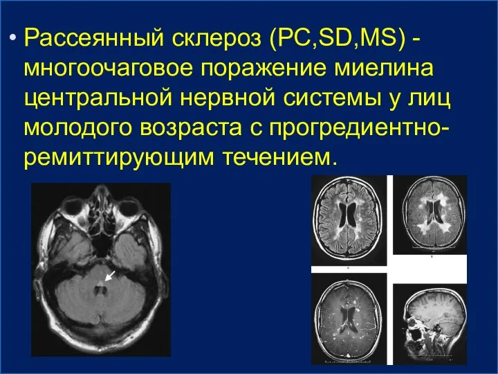 Рассеянный склероз (РС,SD,MS) - многоочаговое поражение миелина центральной нервной системы у