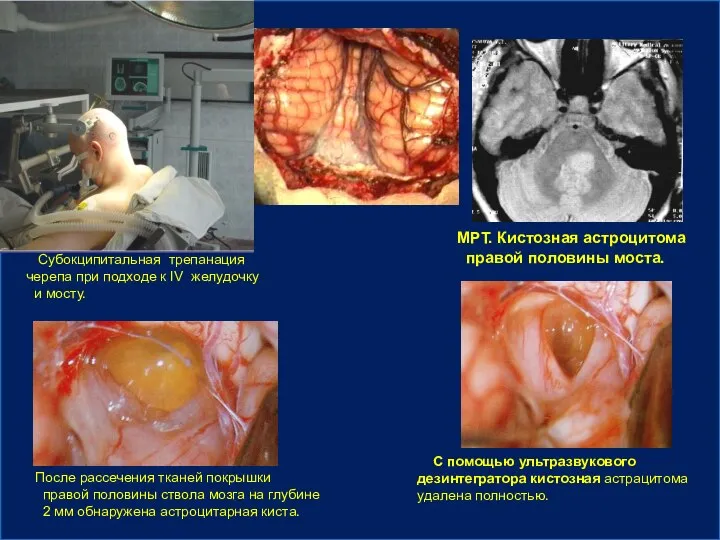 Субокципитальная трепанация черепа при подходе к IV желудочку и мосту. МРТ.