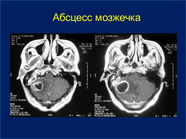 Абсцесс мозжечка