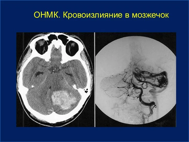 ОНМК. Кровоизлияние в мозжечок