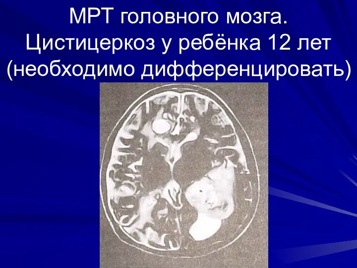 МРТ головного мозга. Цистицеркоз у ребёнка 12 лет (необходимо дифференцировать)