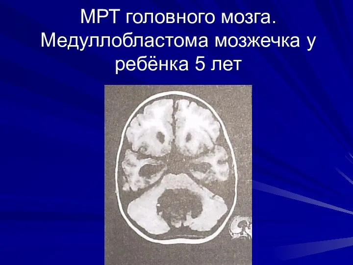 МРТ головного мозга. Медуллобластома мозжечка у ребёнка 5 лет