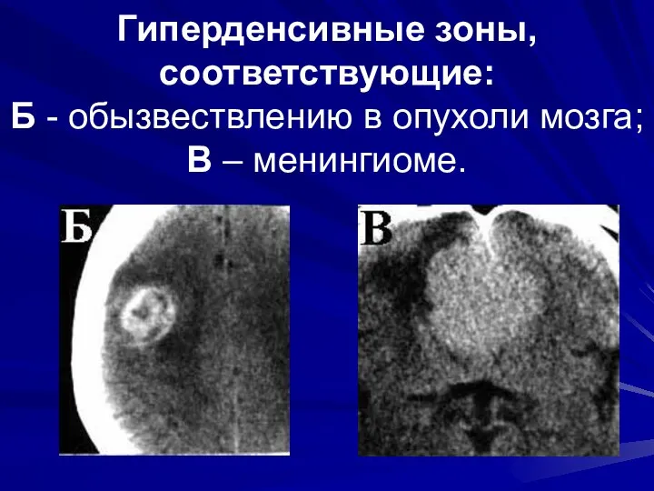 Гиперденсивные зоны, соответствующие: Б - обызвествлению в опухоли мозга; В – менингиоме.