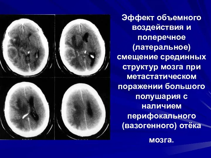 Эффект объемного воздействия и поперечное (латеральное) смещение срединных структур мозга при