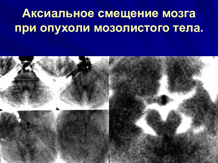 Аксиальное смещение мозга при опухоли мозолистого тела.