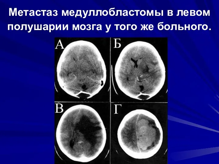 Метастаз медуллобластомы в левом полушарии мозга у того же больного.