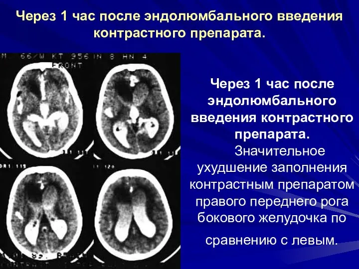 Через 1 час после эндолюмбального введения контрастного препарата. Значительное ухудшение заполнения