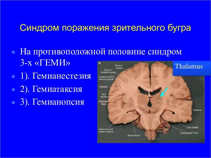 Синдром поражения зрительного бугра На противоположной половине синдром 3-х «ГЕМИ» 1).