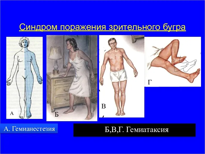 Синдром поражения зрительного бугра А. Гемианестезия Б,В,Г. Гемиатаксия А Б В Г