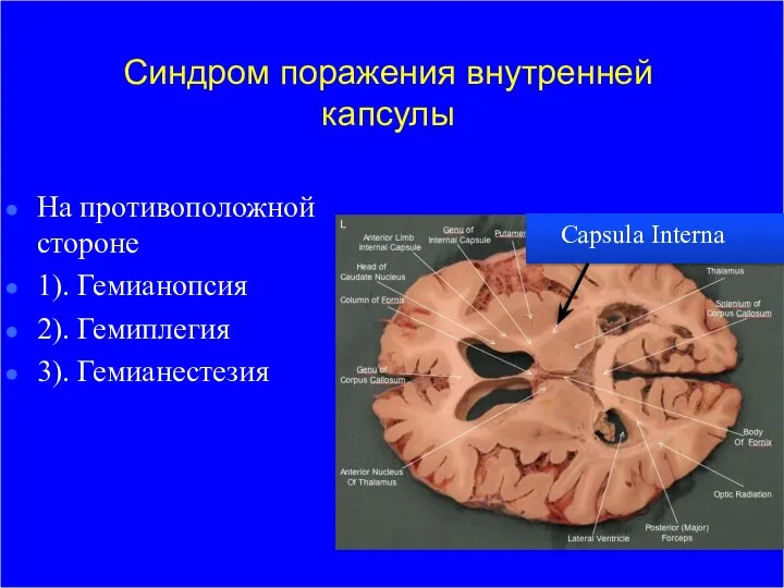 Синдром поражения внутренней капсулы На противоположной стороне 1). Гемианопсия 2). Гемиплегия 3). Гемианестезия Capsula Interna