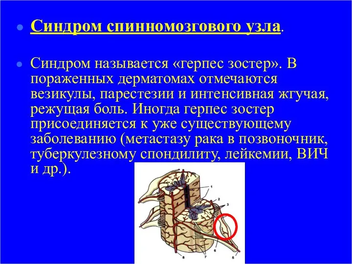 Синдром спинномозгового узла. Синдром называется «герпес зостер». В пораженных дерматомах отмечаются