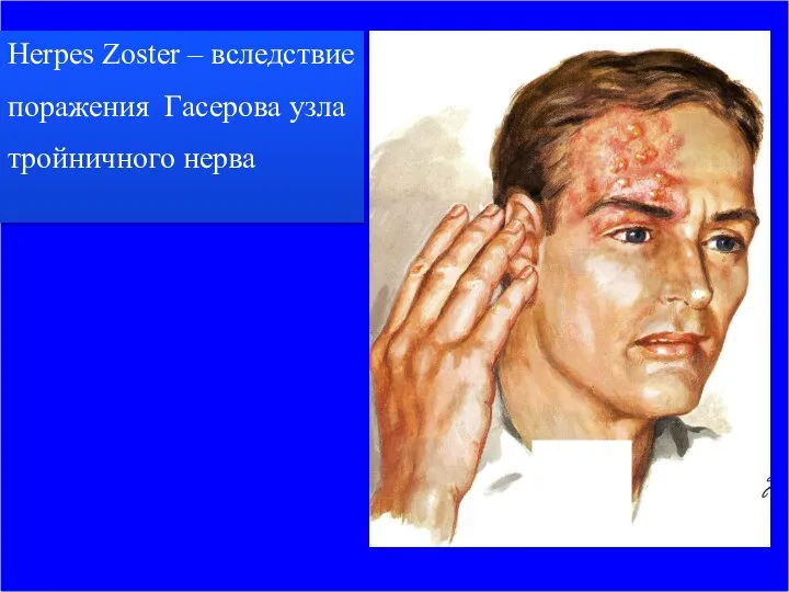 Herpes Zoster – вследствие поражения Гасерова узла тройничного нерва
