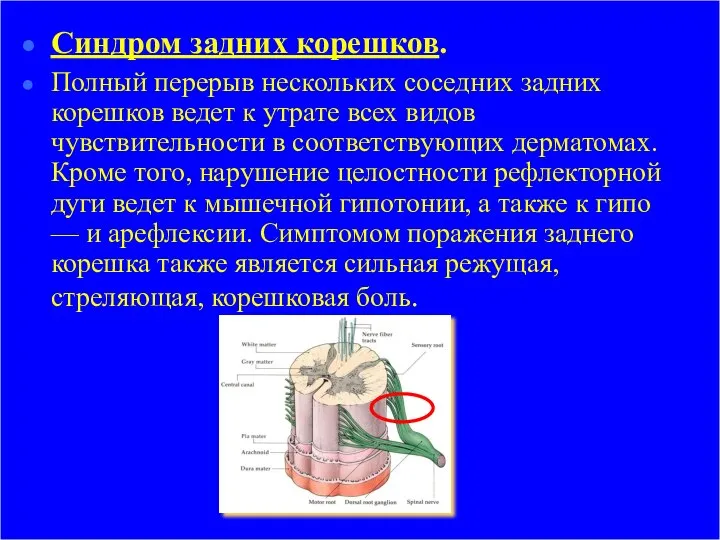 Синдром задних корешков. Полный перерыв нескольких соседних задних корешков ведет к