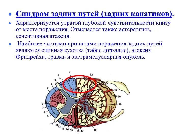 Синдром задних путей (задних канатиков). Характеризуется утратой глубокой чувствительности книзу от