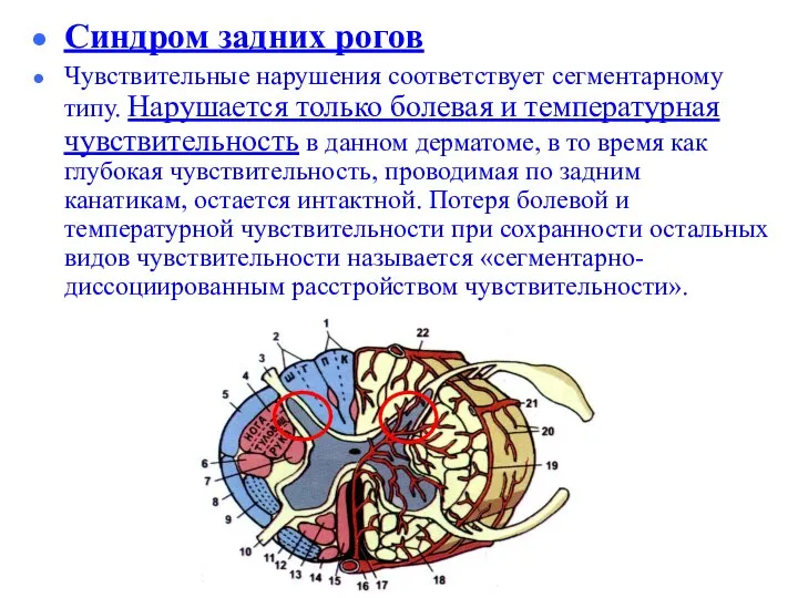 Синдром задних рогов Чувствительные нарушения соответствует сегментарному типу. Нарушается только болевая