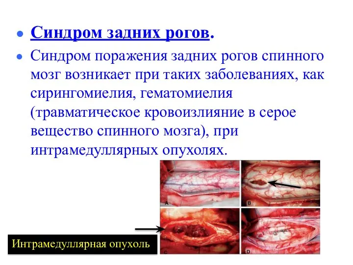 Синдром задних рогов. Синдром поражения задних рогов спинного мозг возникает при